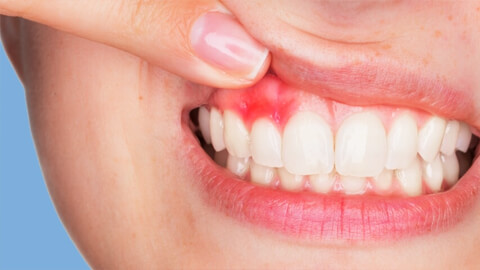 удаление зуба без боли