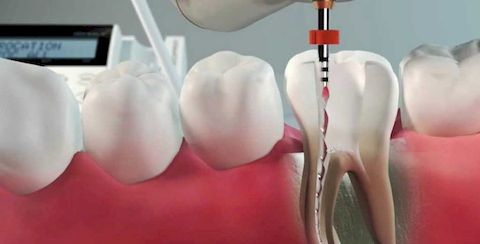 Как успокоить зубной нерв ☀️ Самые эффективные средств от зубной боли🦷 | CIS