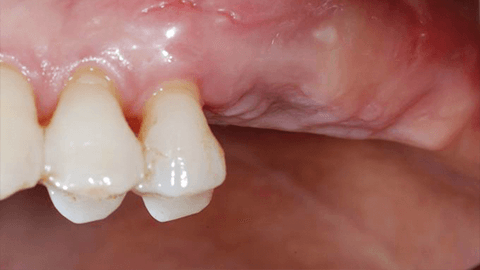 адентия полная зубов