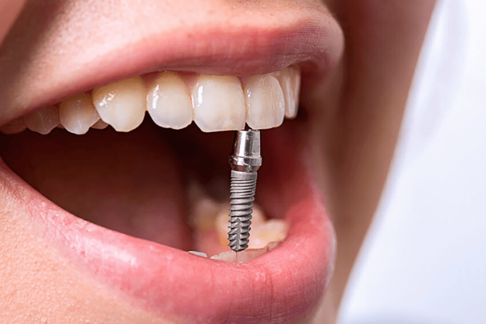 Удаление зубного имплантата