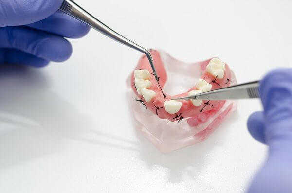 Снятие швов в стоматологии