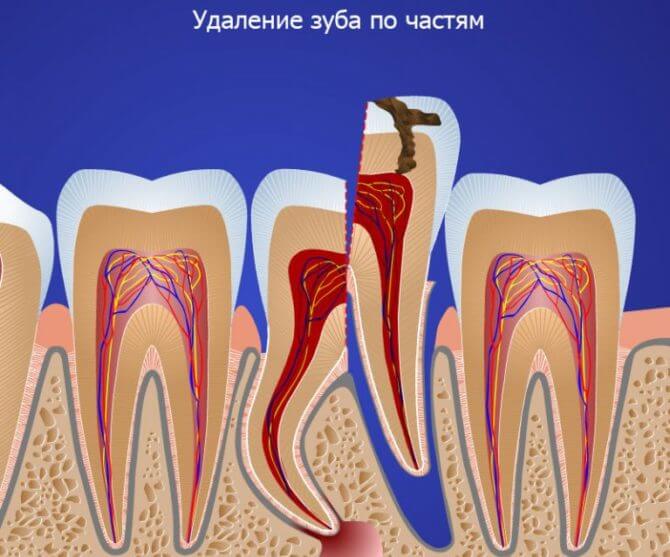 Удаление фрагмента зуба