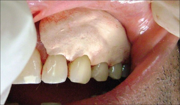 Перевязка в стоматологии