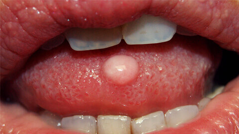 фиброма полости рта