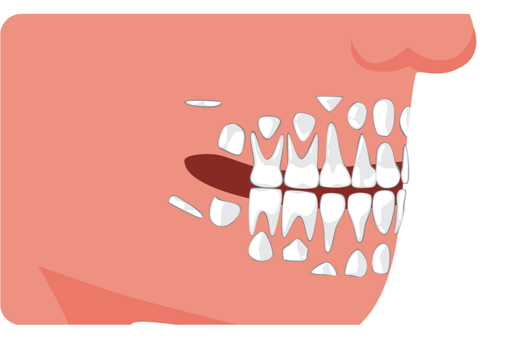 vypadenie-molochnyh-zubov2