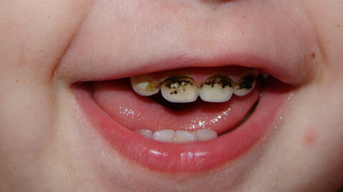 серебрение зубов без смс