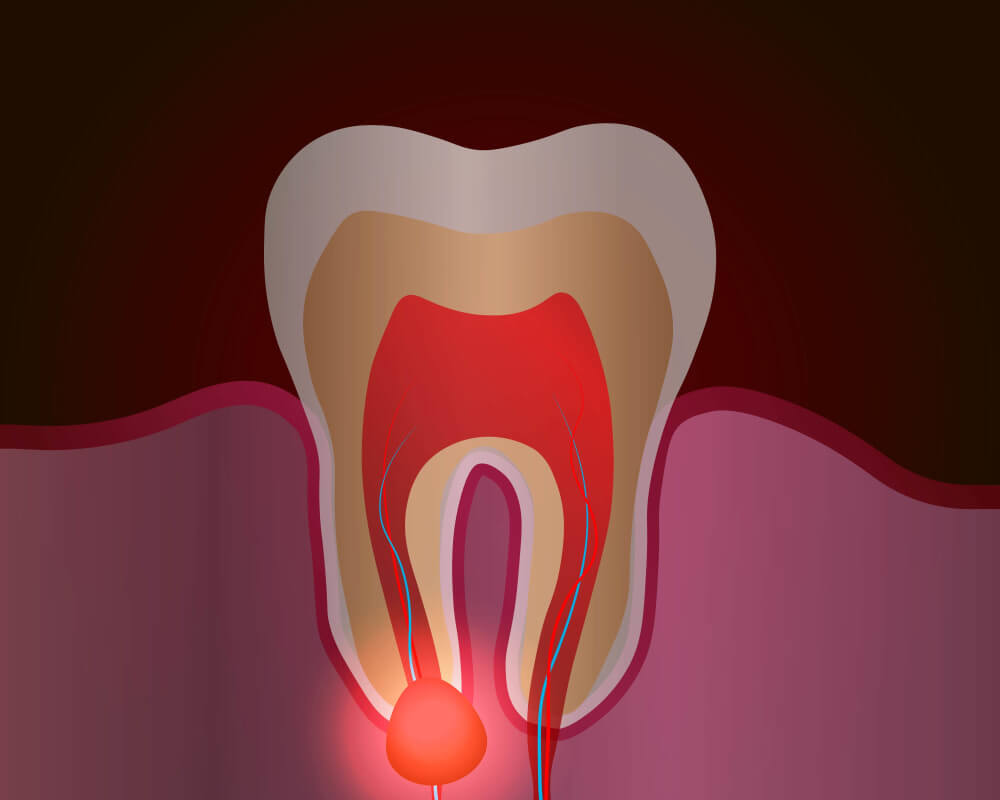 удаление кисты зуба