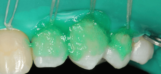 lechenie-zubov-bez-sverleniya-icon1.png