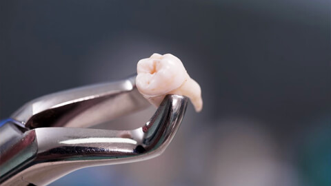 удаление подвижного зуба