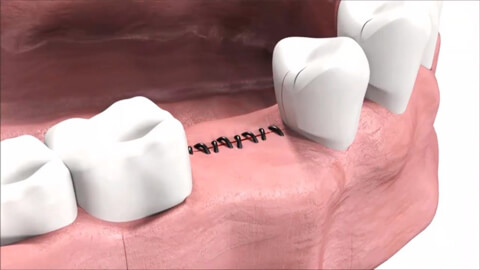 виды швов стоматология