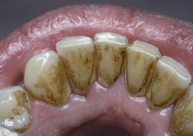 Зубной камень — как убрать, причины и профилактика