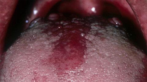 эритроплаксия полости рта