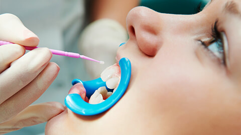 фторирование зубов молочных