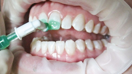lechenie-zubov-bez-sverleniya-icon2.jpg