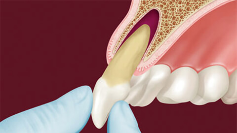 реплантация зуба