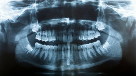 рентген зуба