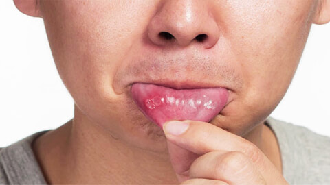 Декубитальная язва полости рта 