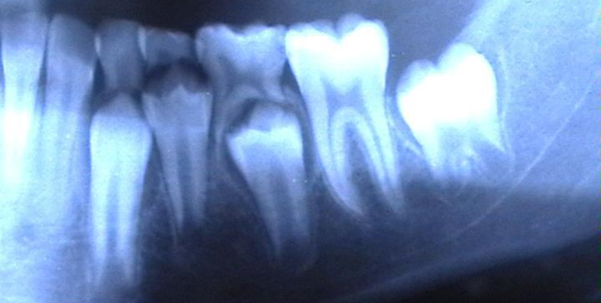 vypadenie-molochnyh-zubov3
