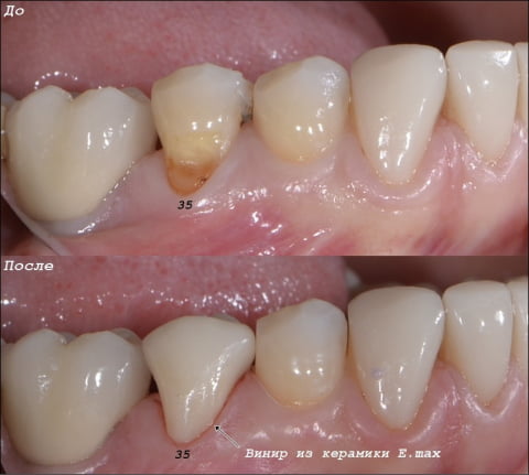 Клиновидный дефект зуба - причины, диагностика, симптомы