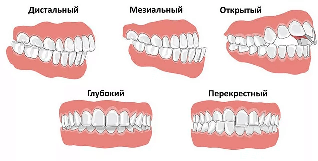 виды неправильного прикуса виды неправильного прикуса