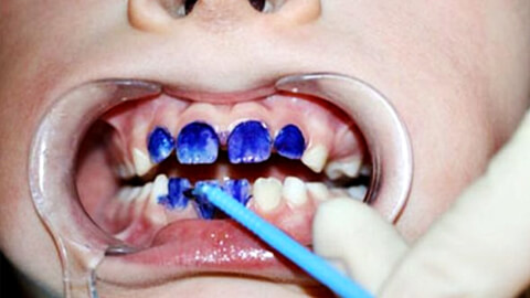 серебрение зубов