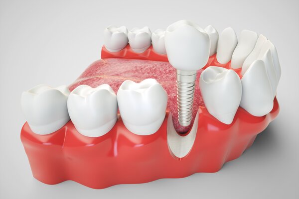 Показания к 3D снимку зубов