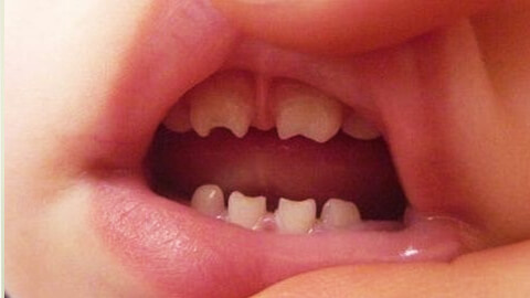 аномалии формы зубов