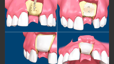 Остеопластика в стоматологии