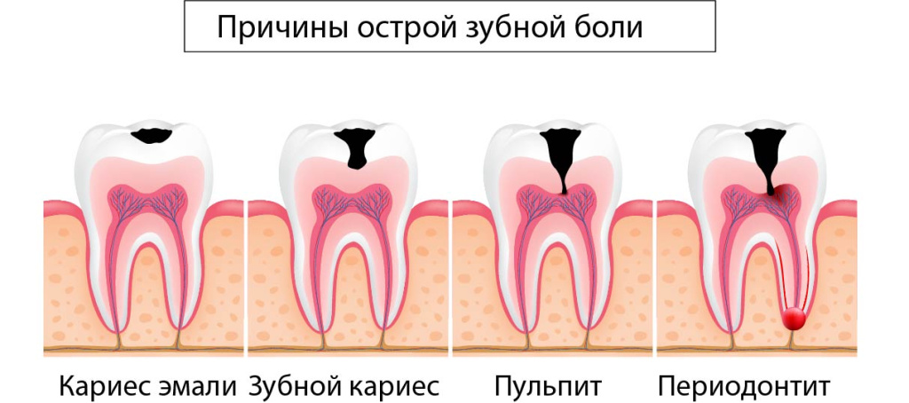 острая зубная боль 1.jpg