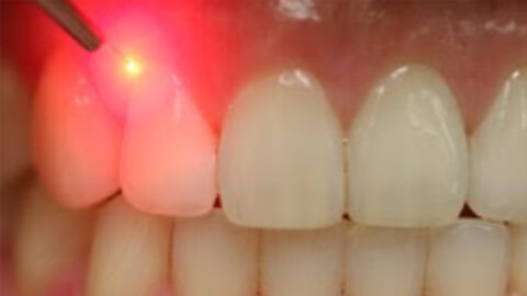 лазерная чистка зубов