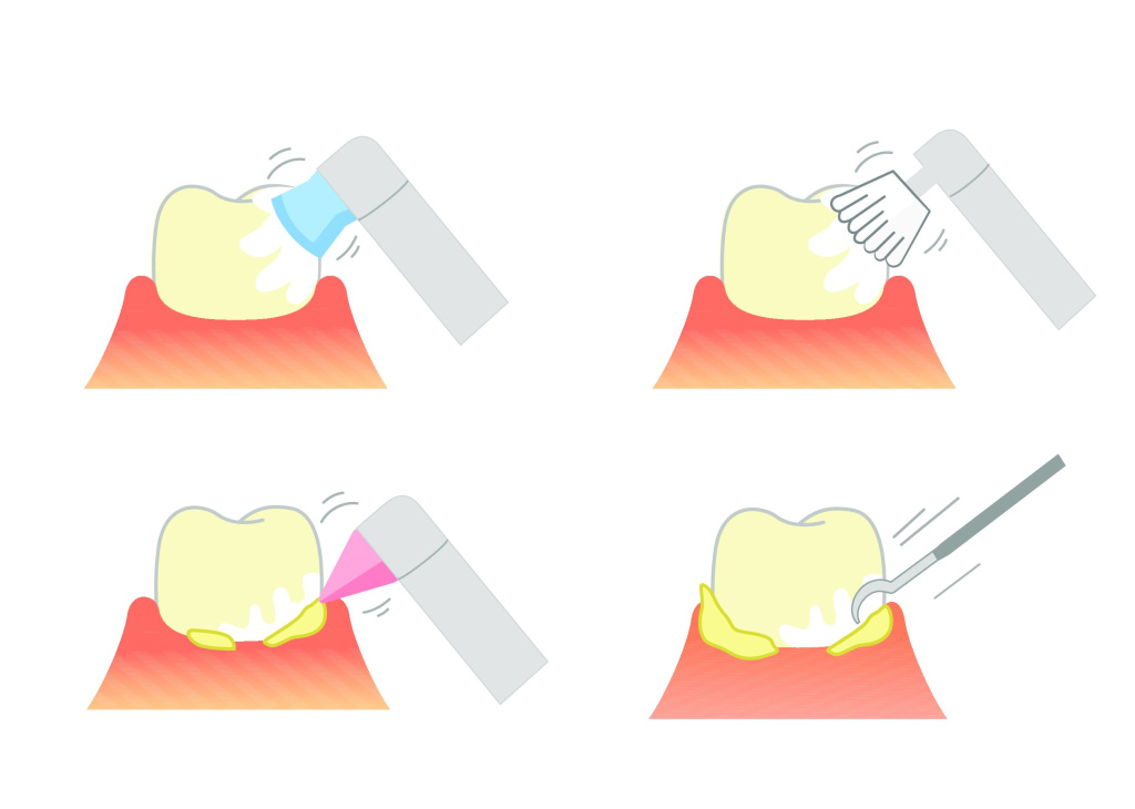 Методы удаления зубных отложений