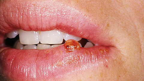 Кератоакантома губ